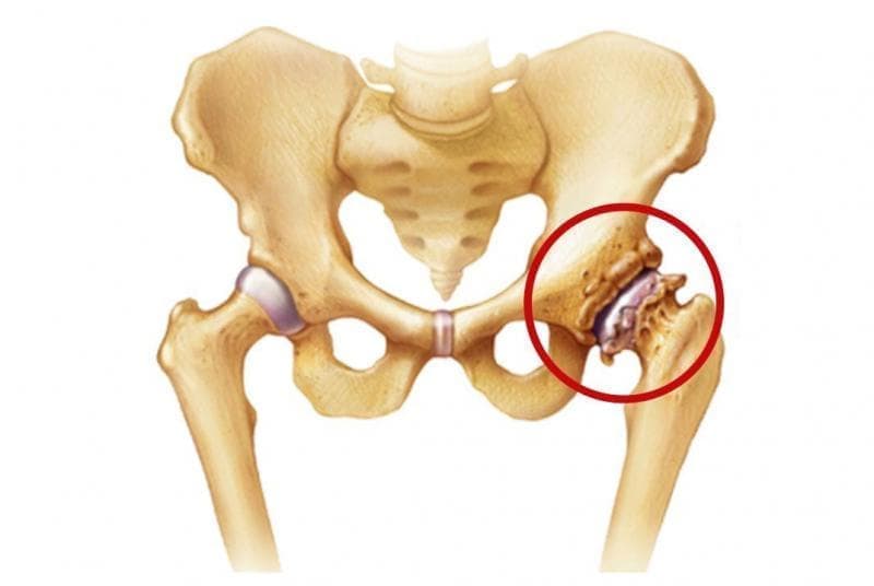 Коксартроз.jpg